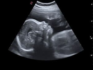 2D Pregnancy Scan