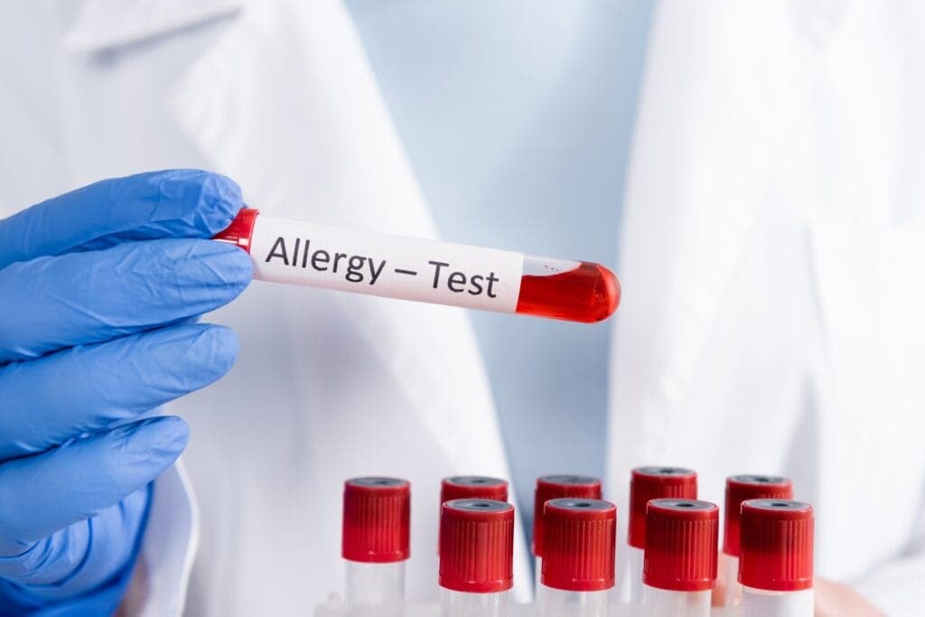 Allergy Testing